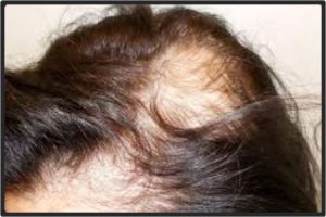 Como superar la alopecia femenina
